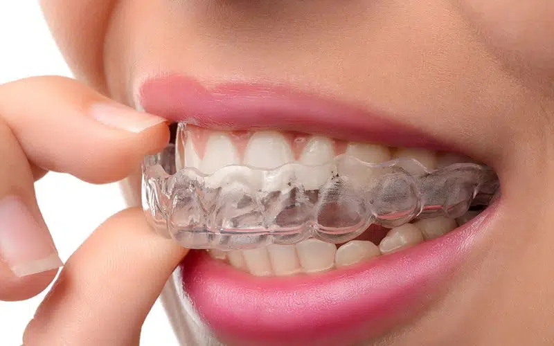 teeth guard 1