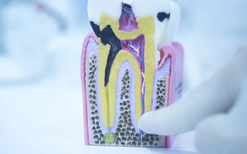 root canal