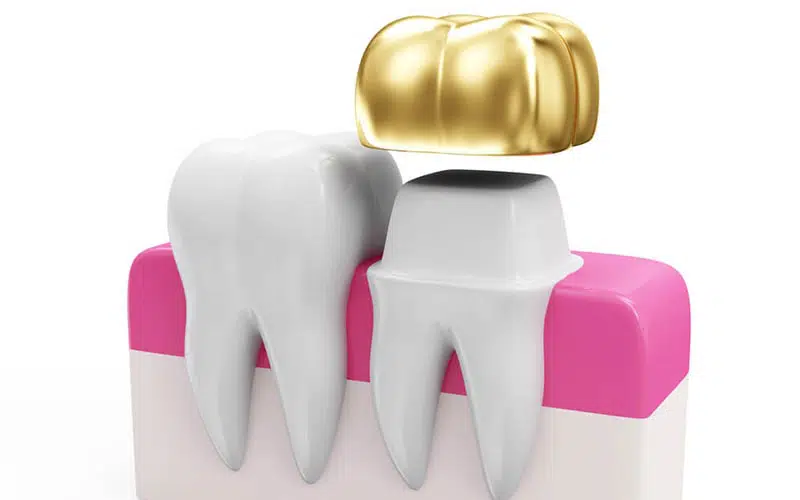 tooth crown 1