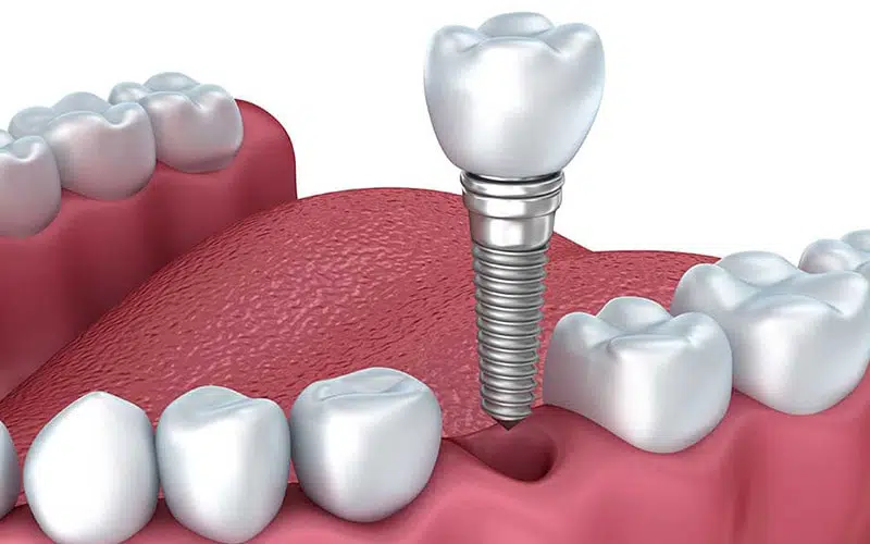 tooth root