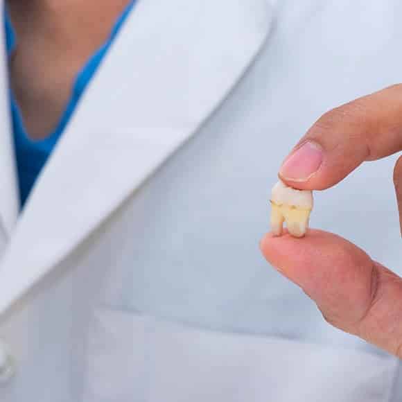 wisdom-tooth-removal-min