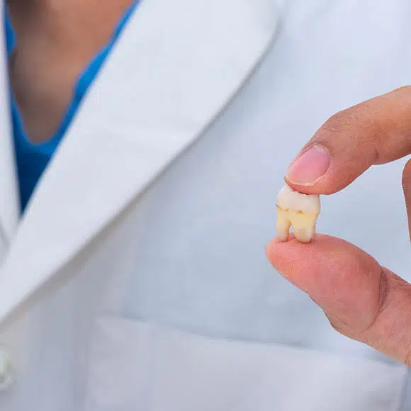 wisdom-tooth-removal-min wisdom-tooth-removal-min