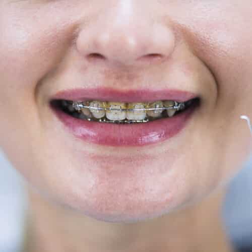 braces-services
