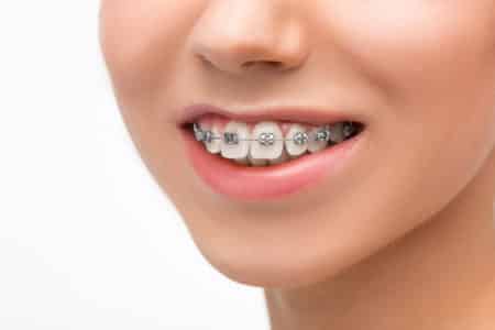 orthodontics Capalaba