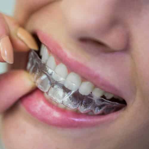 braces and clear aligners Capalaba