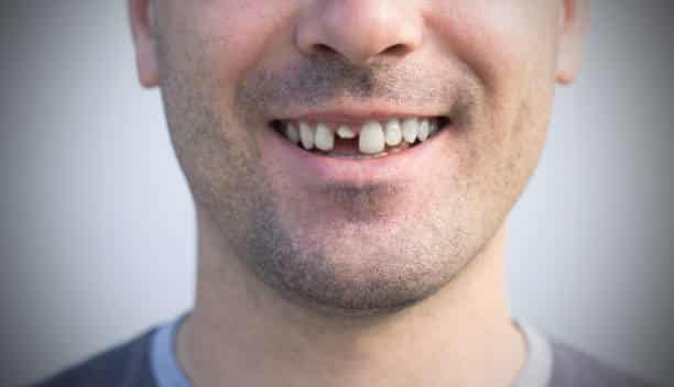 cracked tooth needing a dental crown near Capalaba