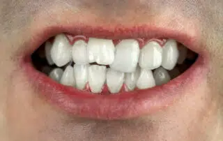 Crooked Teeth