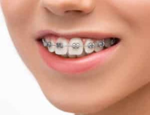 What To Expect When Getting Braces