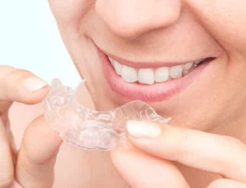 Clear aligners: an alternative to braces