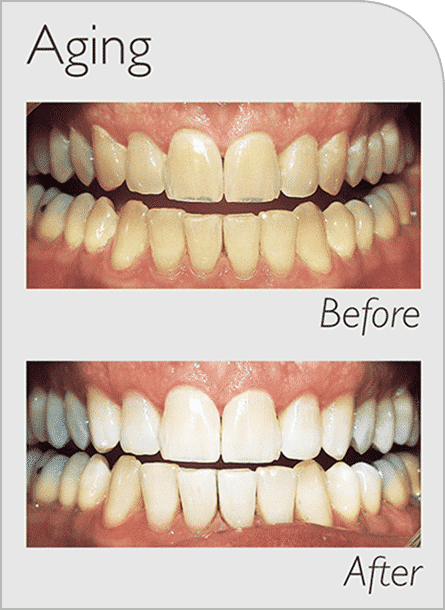 Aging teeth cleaning before and after