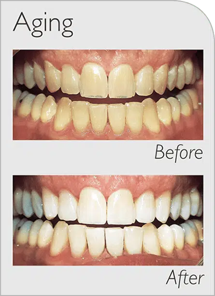 Zoom Before and After Aging new
