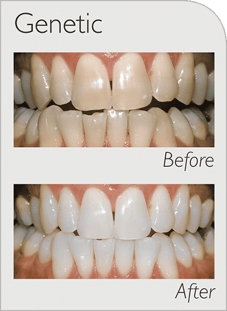 Genetic teeth cleaning before and after
