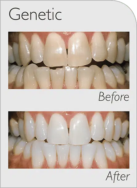 Zoom Before and After Genetic new