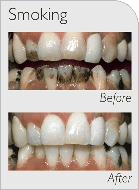cosmetic dentist Capalaba 2022
