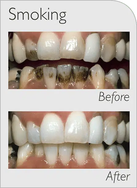 Zoom Before and After Smoking new cosmetic dentist Capalaba 2022