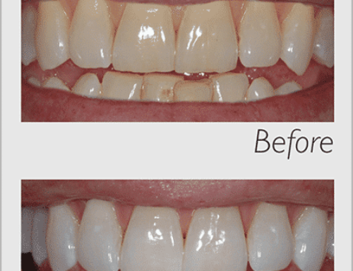 Teeth Straightening Options Brisbane 2022