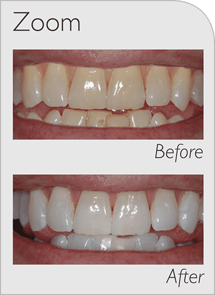 Dental cleaning before and after