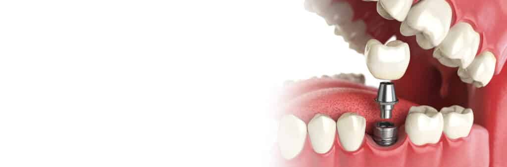 dental implant treatment Capalaba