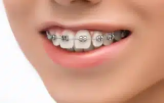 Close-up of a person smiling with traditional metal dental braces on upper teeth.